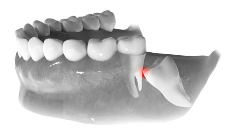 Wisdom Teeth Removal White Rock Dental Group