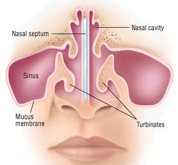 Deviated Septum Guide Causes Symptoms And Treatment Options
