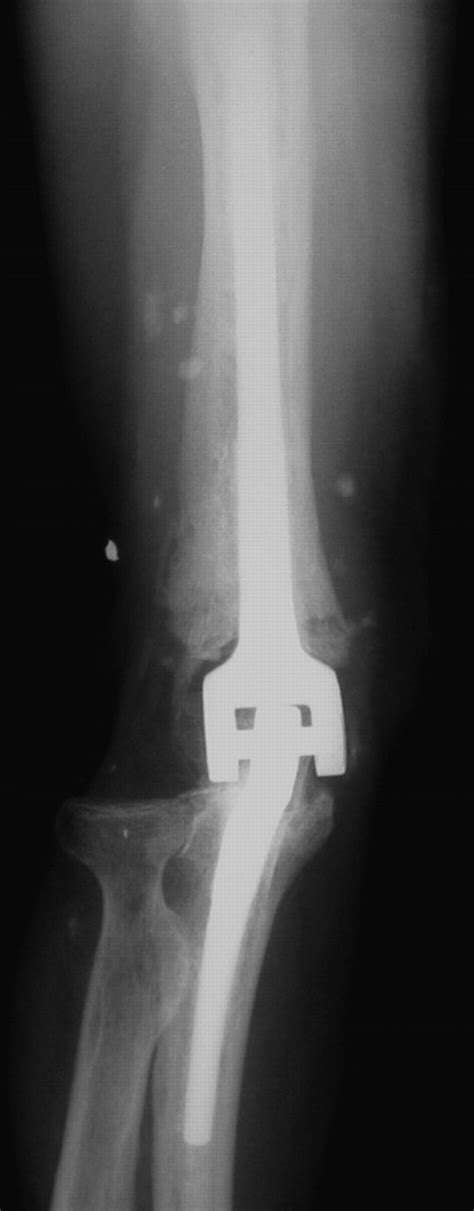 Coonrad Morrey Total Elbow Arthroplasty For Tumours Of The Distal