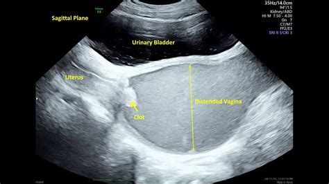 Hematocolpos Secondary To Imperforate Hymen Ultrasound Youtube