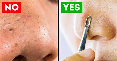 4 Ways To Effectively Remove And Avoid Blackheads