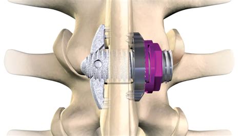 Spinal Fusion Addressing Complications And Risks Of The Surgery