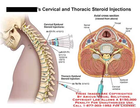 Amicus Illustration Of Amicus Surgery Injection C T T T Cervical