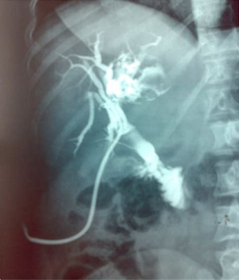 Postoperative Cholangiography Showing The Persistence Of The Biliary