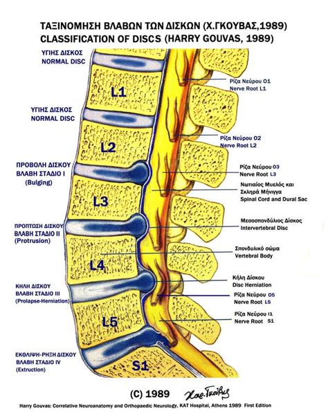 Κήλη μεσοσπονδυλίου δίσκου Schroth Scoliosis And Spine Clinic