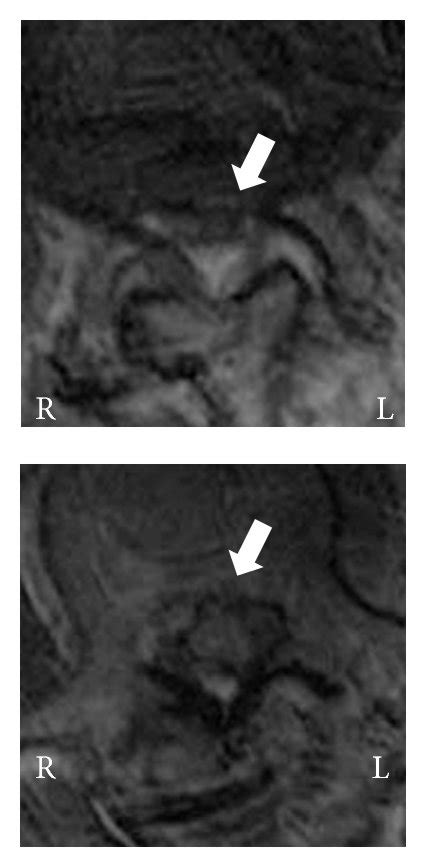 A Sagittal T2 Weighted Magnetic Resonance Image At The Time Of