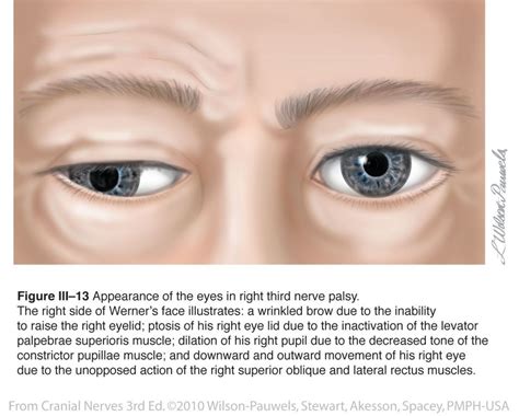 Oculomotor Iii Cranial Nerves With Images Cranial Nerves Nerve