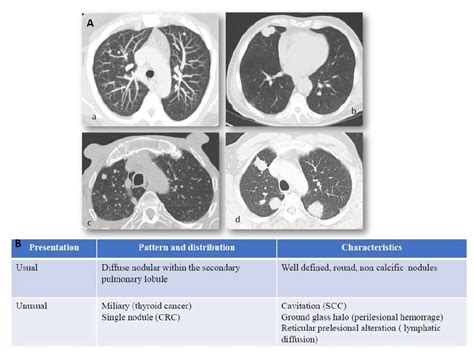 Lung Metastases Imaging And Immunostaining In Patients With Known