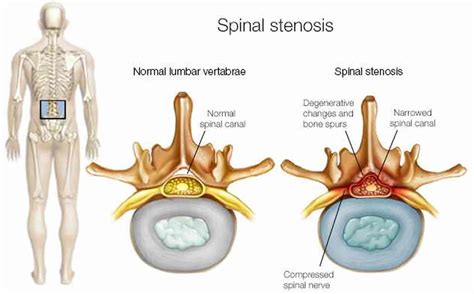 Back Surgery Lower Back Surgery Indications Types Risks And Complications