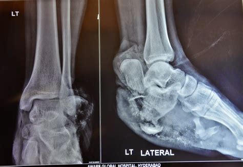 Bilateral Foot Crush Injury Heel Pad Avulsion Communited Calcaneal