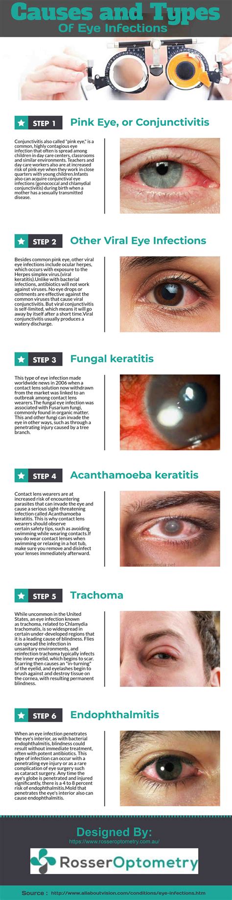 Infographics | Infographic, Eye infections, Pink eyes