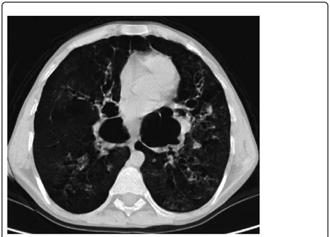 High Resolution Computed Tomography Of Chest In Lung Window Shows