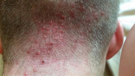 What Is Folliculitis How To Treat It And How It Affects Hair Health Insalaco Clinic