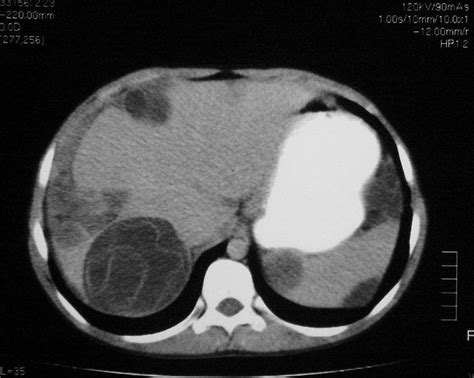 Ct Scan Showing Hydatid Cyst In The Abdominal Cavity Involving The