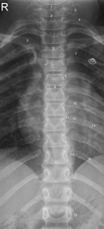 The Spinal Column And Its Contents Radiology Key