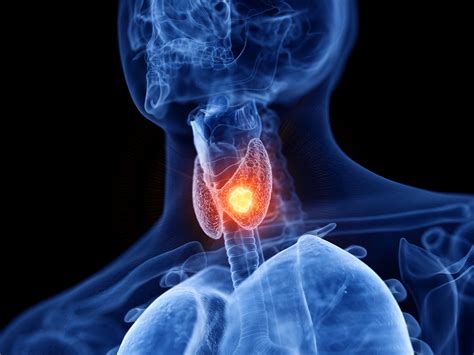 Thyroid Nodules