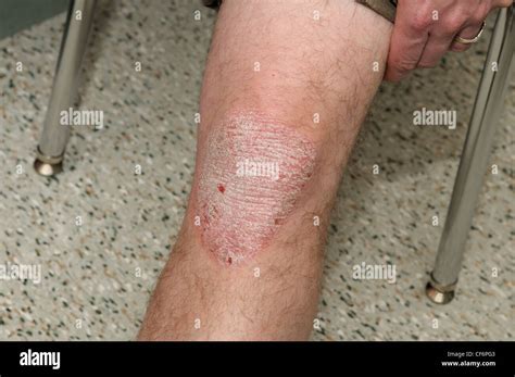 Plaque Psoriasis Knee Hi Res Stock Photography And Images Alamy