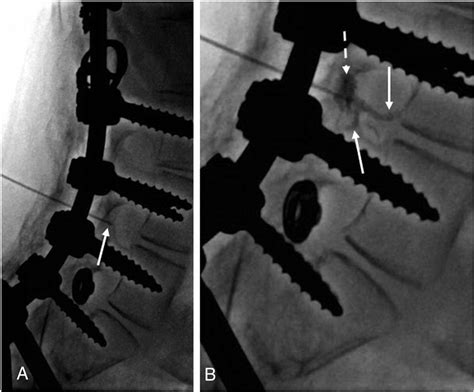 Simple Fluoroscopy Guided Transforaminal Lumbar Puncture Safety And