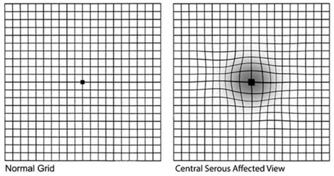 Squiggly Lines Blurry Vision Should You Always Seek Treatment For