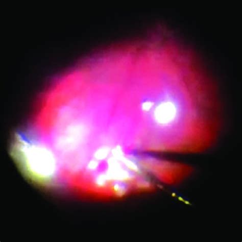 Improved Retinal View Through A Multifocal Iol Under Air Using A
