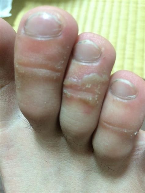 足の指の関節に…水ぶくれ(画像あるのでグロいかも) - OKWAVE