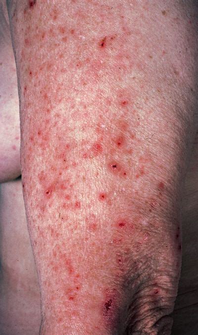 Dermatitis Herpetiformis Coeliac Disease Itching Skin Thyroid Disease