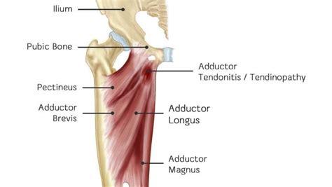 The following groin strengthening exercises are designed to improve strength of the groin (adductor) muscles (figure 1). Groin Muscles Diagram - Physical Therapy Guide To Groin Strain Choosept Com - A groin strain is ...