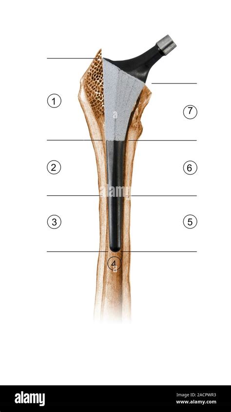 Prosthetic Hip Joint And Gruen Zones Cutaway Diagram Of A Femur Thigh