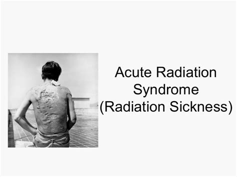 Acute Radiation Syndrome
