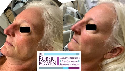Bbl Photofacial Before And After Photos Dr Robert Bowen Martinsburg Wv