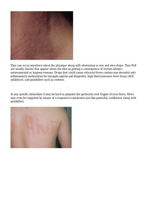 The Recommended Approach For Treating Ones Dermatographic Urticaria Is