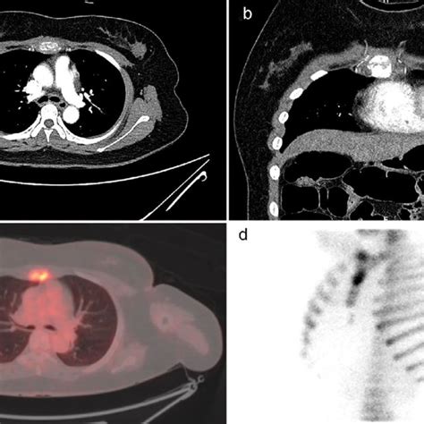 A Chest Ct Scan Axial View Showed A Mass And A Pathological