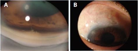 Removing A Malpositioned Shunt Glaucoma Today