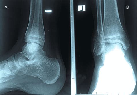 Cureus Giant Cell Tumor Of The Distal Fibula Managed By An Autologous