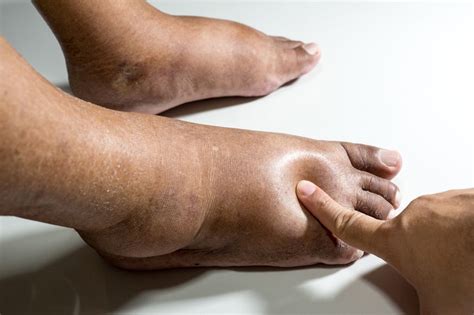 11 Reasons Why You Have Swollen Feet Ankles Or Legs