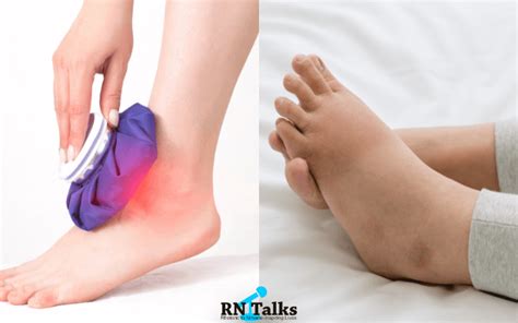Difference Between Swelling And Edema Or Oedema Rntalks