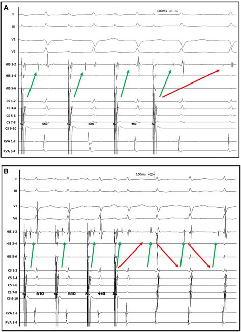 Induction Of Double Ventricular Response And AVNRT In The Same Patient Download Scientific