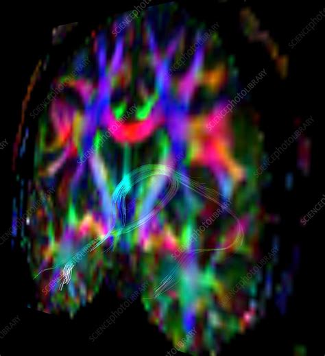 Fornix Hippocampus And Mammillary Body Dti Stock Image C0366110