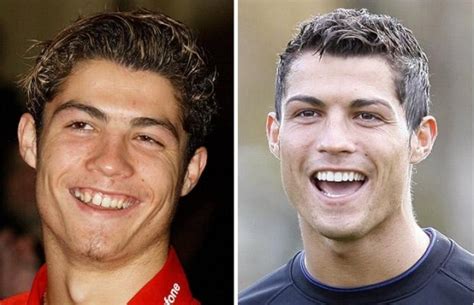 Cristiano Ronaldo Teeth Plastic Surgery Before And After Photos 2018