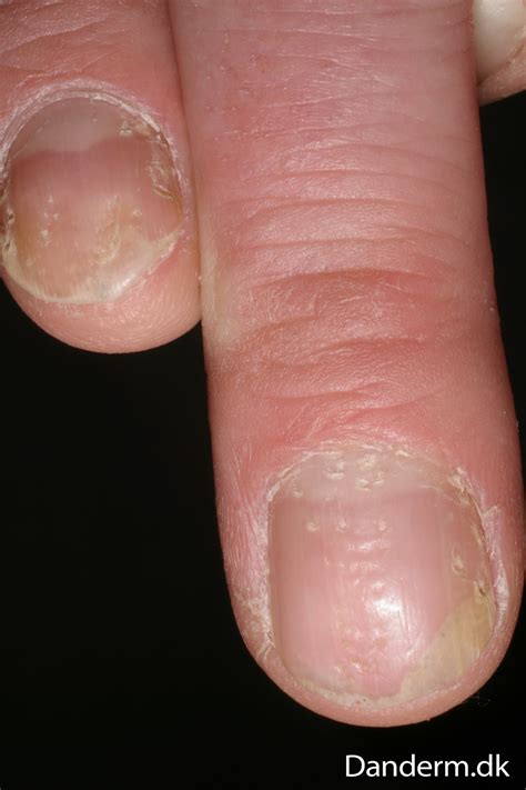 4 74 15 Psoriasis Of The Nails