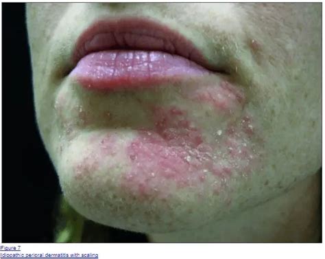 How To Treat Perioral Dermatitis Naturally And Quickly