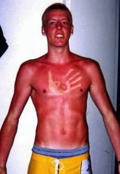 10 Hilarious Examples Of Sun Tans Gone Very Wrong Bad Sunburn