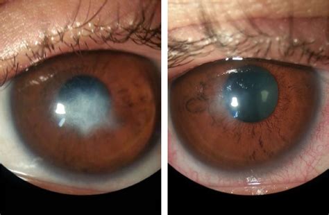 Severe Case Of Corneal Abscess In A Patient With Acute Keratoconus