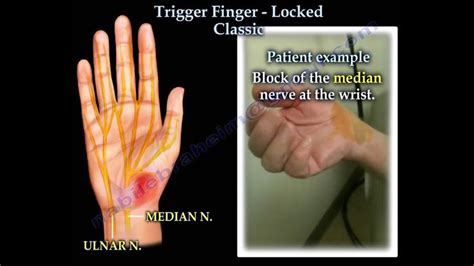 Trigger Finger Locked Classic Everything You Need To Know Dr Nabil