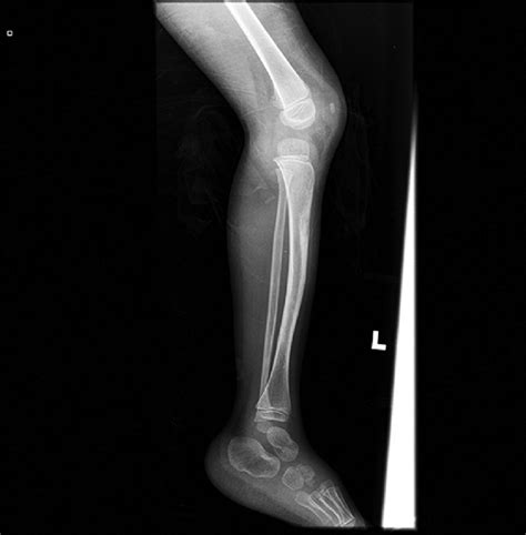 Lateral Radiograph Of Left Tibia And Fibula Of Patient Showing Anterior