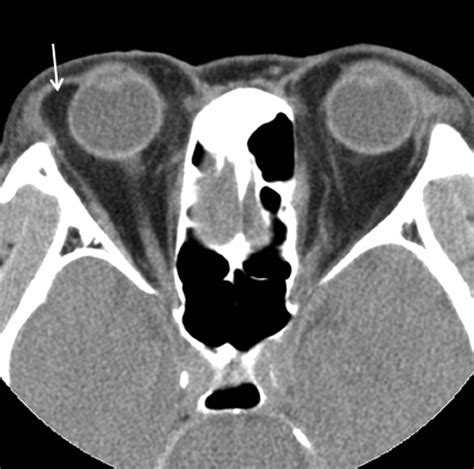 Subconjunctival Fat Prolapse And Dermolipoma Of The Orbit Differentiation On Ct And Mr Imaging