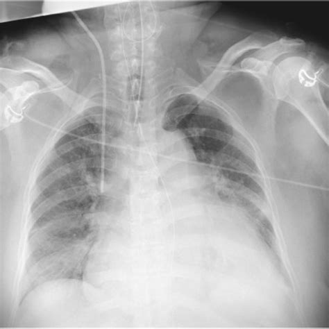 Chest Radiography Cardiomegaly And Bilateral Costophrenic Angle