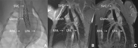 X Ray Fluoroscopy Versus Interventional Cardiac Mri Icmr This Figure