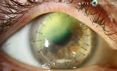 Keratitis is a common inflammation of the cornea, which can be caused by a bacteria, injury to the eye, or dry eyes. Confocal microscopy in fungal keratitis