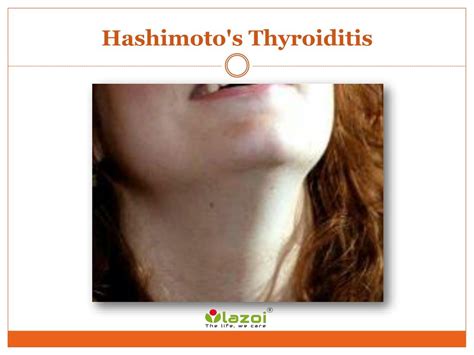 Ppt Hashimotos Thyroiditis The Most Common Form Of Thyroiditis